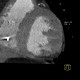 Subendocardial infarct of posterior wall of the left ventricle: CT - Computed tomography